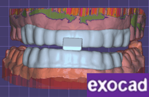 ExoCad: Anterior Discluder & Lower Slider
